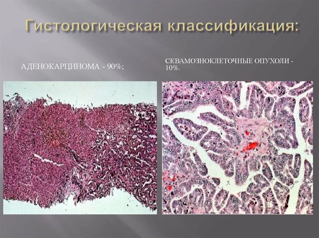 Гистологического строения опухоли