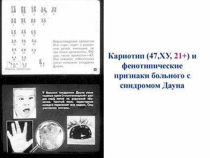 Кариотип 47 ху