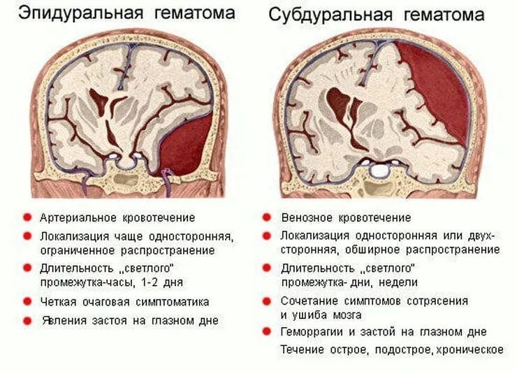 Субдуральное кровоизлияние головного мозга. Субдуральная и субарахноидальная гематома. Симптомы субдуральной гематомы. Сдавление головного мозга внутричерепными гематомами. Давление при травме головы