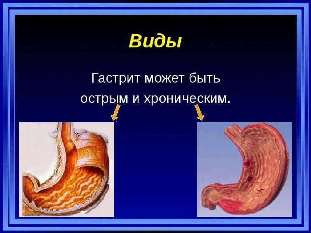 Острый и хронический гастрит. Острый гастрит презентация. Характер гастрита