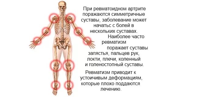 Симметричное заболевание. При ревматоидном артрите поражаются суставы. Схема поражения суставов при ревматоидном артрите. При ревматоидном артрите преимущественно поражаются суставы. Симптомы поражения суставов ревматоидного артрита.