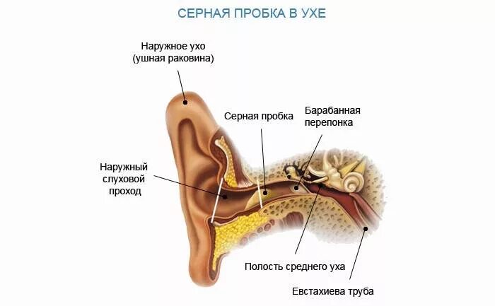 Как убрать ушную пробку перекисью водорода