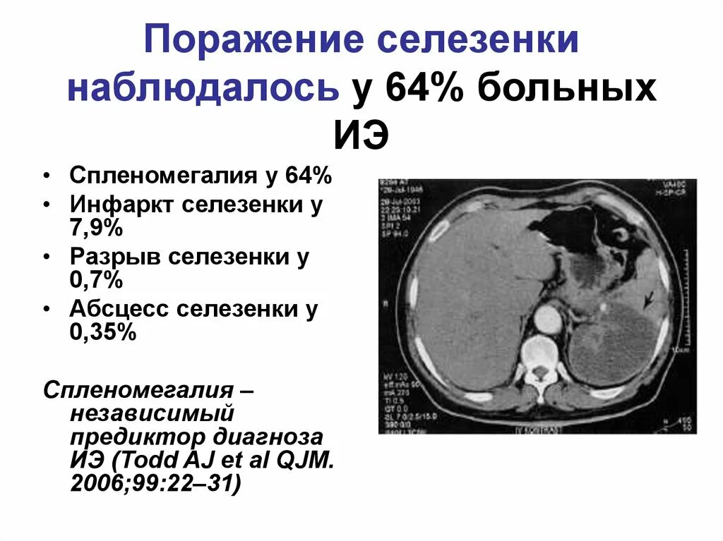 Патология селезенки. Варианты поражения селезенки при инфекционном эндокардите. Инфаркт и абсцесс селезенки кт. Исход инфаркта селезенки УЗИ.