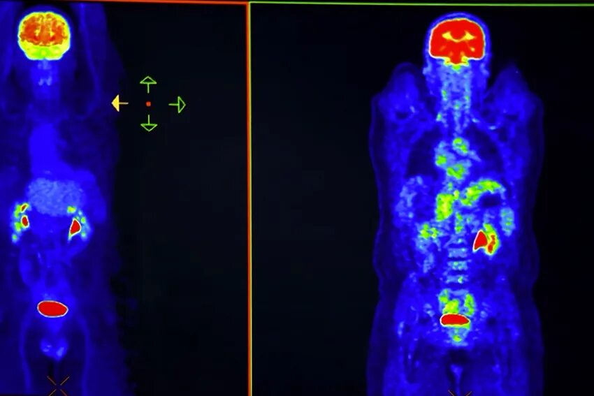 Как пройти пэт кт. Позитрон-эмиссионная томография. Позитрон-эмиссионная томография метод ядерной медицины. ПЭТ исследование тела.