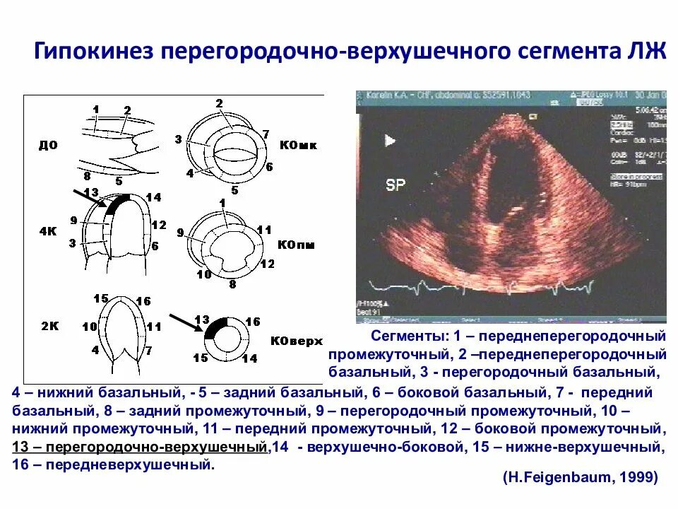 Зоны гипокинезии на эхокг. Сократимость миокарда нормокинез. Сегменты левого желудочка эхокг схема. Гипокинез стенок левого желудочка. Зоны левого желудочка эхокг.