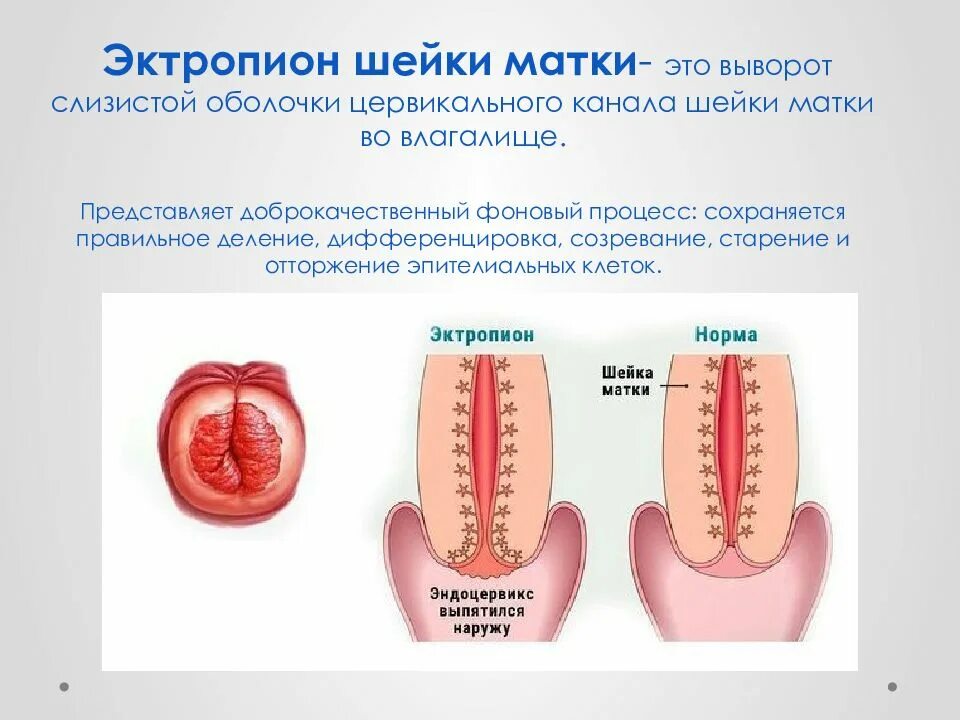 Эктропион матки лечение. Рубцовая деформация эктропион шейки матки. Эктропион матки лечение. Эрозия и эктропион шейки. Эктропиона кольпоскопия.