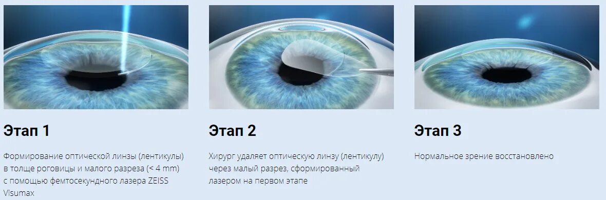 Сколько восстанавливается зрение после лазерной. Лазерная рефракционная кератопластика по технологии LASIK. Smile технология лазерной коррекции зрения. Коррекция зрения Фемто ласик. Рефракционная экстракция лентикулы.