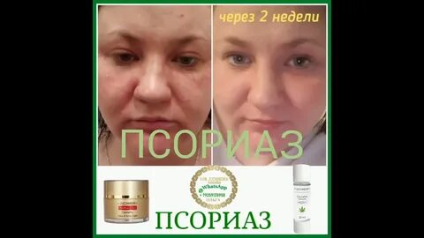 Псориаз отзывы