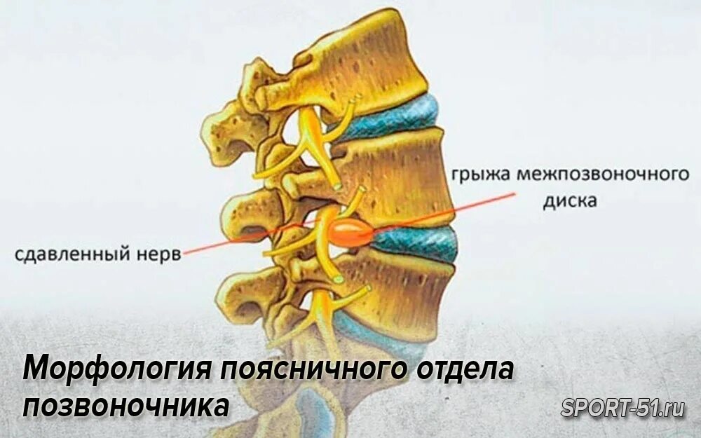 Грыжи дисков поясничного отдела позвоночника. Грыжа межпозвонкового диска поясничного отдела. Протрузии крестцового отдела позвоночника. Грыжа позвонка поясничного отдела.