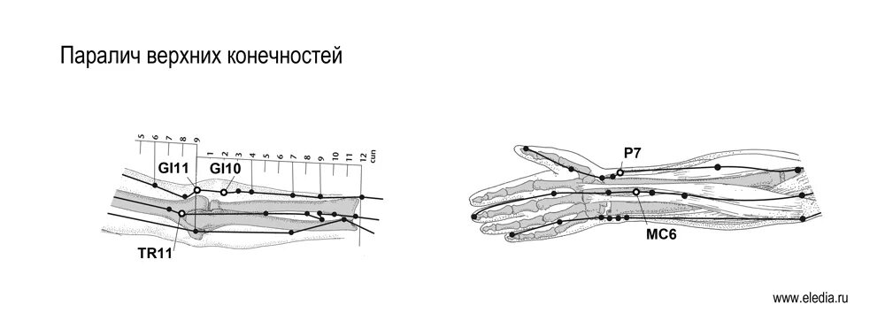 Парез верхних конечностей. Ревматоидный артрит точки акупунктуры. Паралич верхних конечностей. Параплегия верхних конечностей.