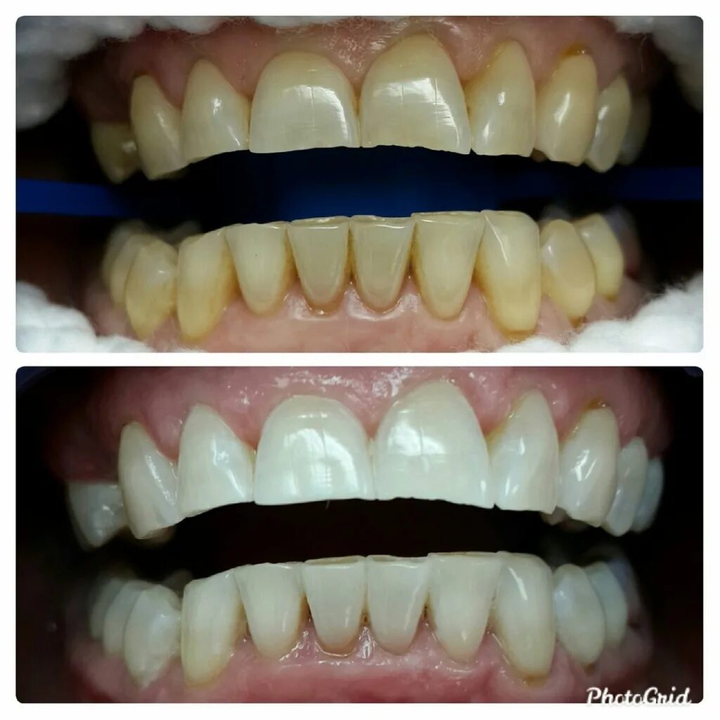 Отбеливание зубов минусы. Отбеливание зубов до и после. Зубы до и после фотоотбеливания.
