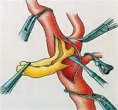 Бляшка на шее операция. Стентирование сонной артерии. Стентирование сосудов шеи. Стентирование артерии шеи. Стентирование сосудов сонной артерии.