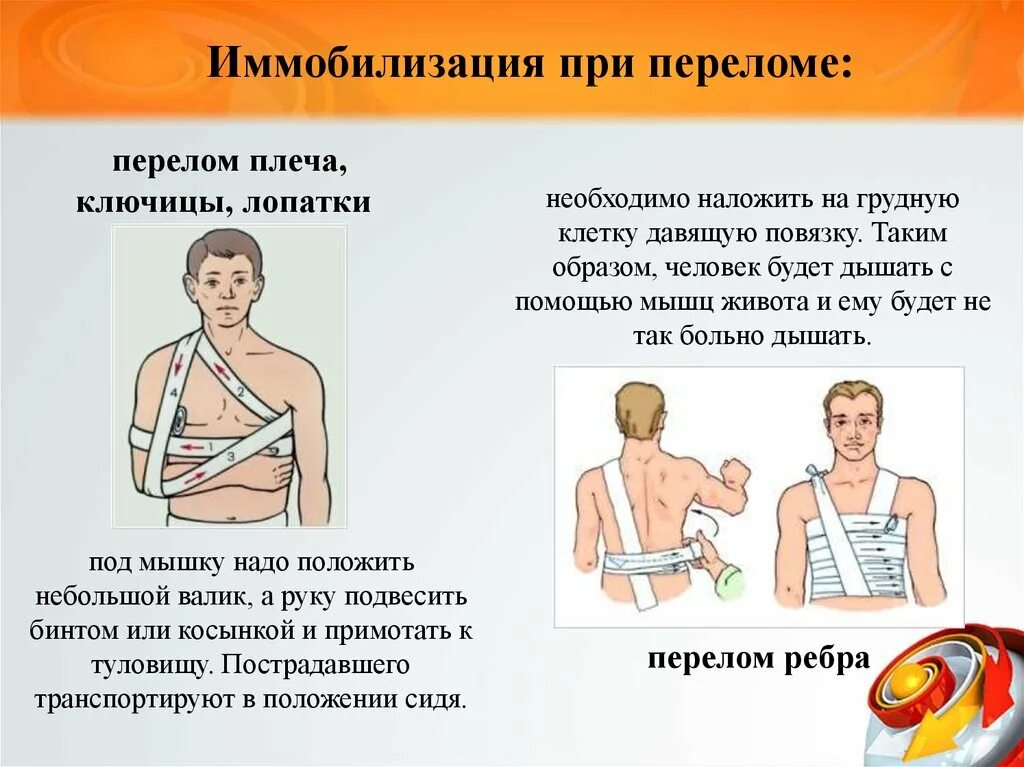 При переломе надо пить. Иммобилизация передома ключиц. Иммобилизация при переломах плеча, ключицы, лопатки. Транспортная иммобилизация при переломе ключицы Дезо. Транспортировкапри переломе клюяицы.