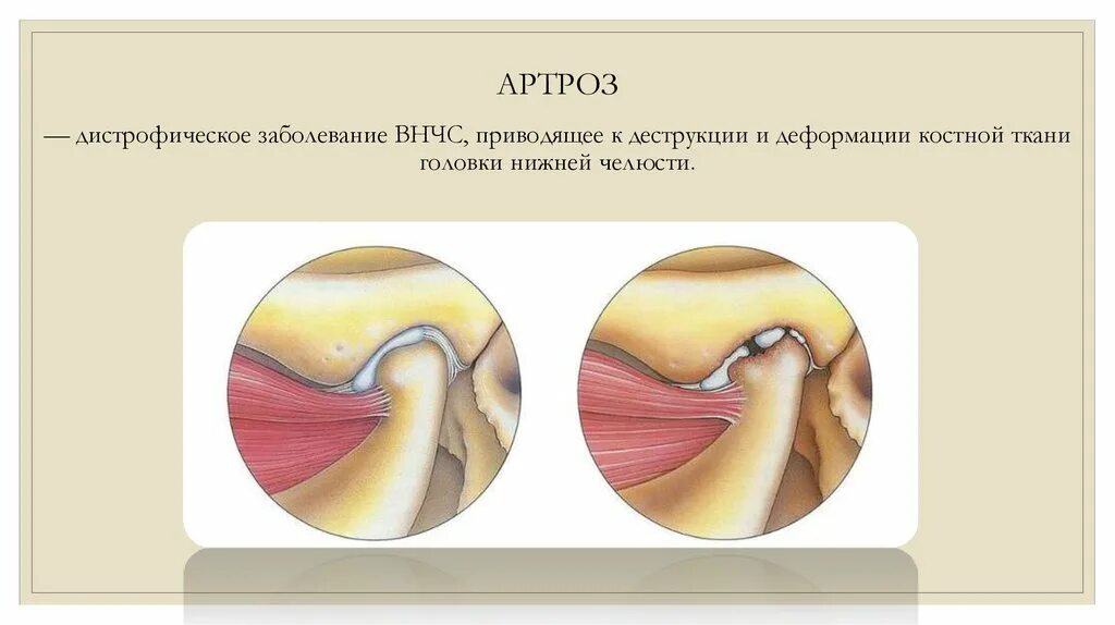 Заболевание нижней челюсти. Деформирующий остеоартроз ВНЧС кт. Артроз височно нижнечелюстного сустава рентгенологически. Артроз ВНЧС классификация. Классификация артритов ВНЧС.