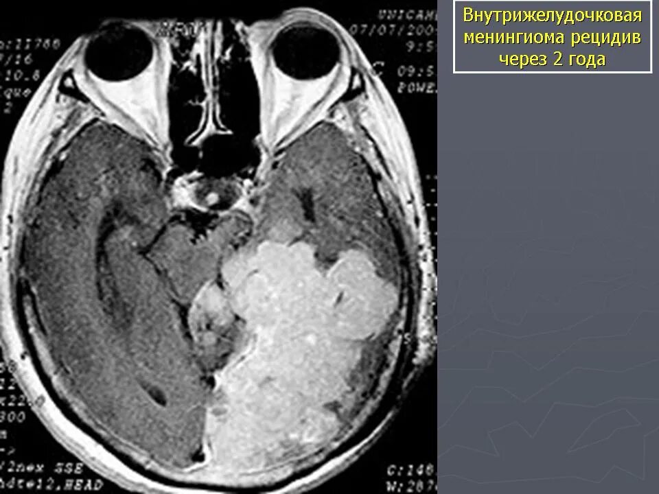 Менингиома апластическая. Внутрижелудочковая менингиома мрт. Менингиома теменной кости.