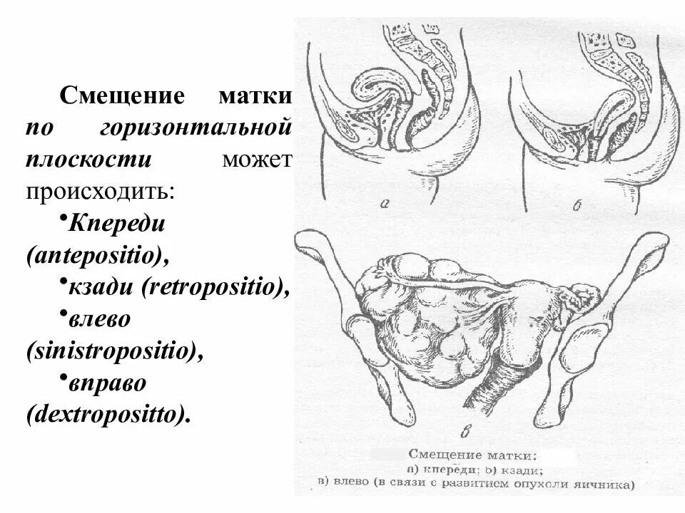 Забеременеть при загибе. Смещение матки по горизонтальной плоскости. Перегиб матки anteflexio. Загиб матки кпереди симптомы. Седловидная матка кзади.