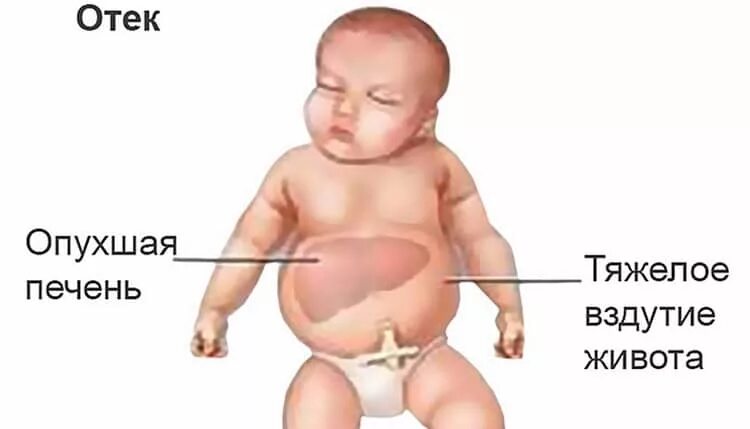 Увеличена печень у новорожденного. Увеличенная печень у ребенка.