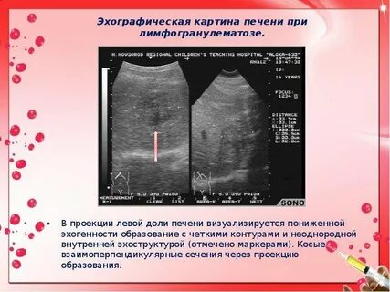 Образование пониженной эхогенности с четкими контурами