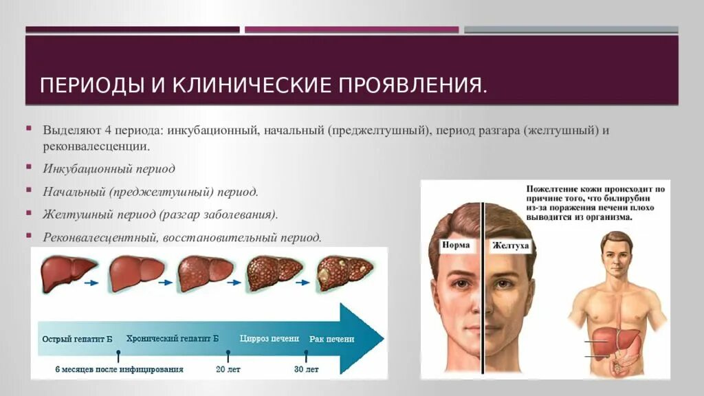 Преджелтушный период гепатита а. Вирусный гепатит а клинические проявления. Симптомы гепатита а желтушный период. Стадии клинических проявлений гепатита а. Вирусный гепатит желтушный период