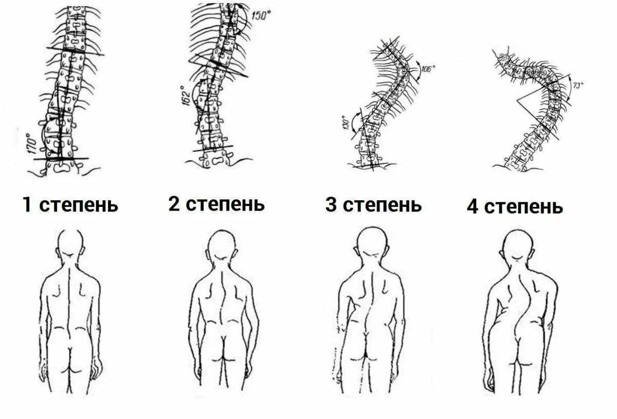 Сколиоза сколиоз степень 3. Сколиоз 2 степени градусы. Z образный сколиоз 2 степени. Сколиоз 1 степени. S образный сколиоз позвоночника 2 степени.