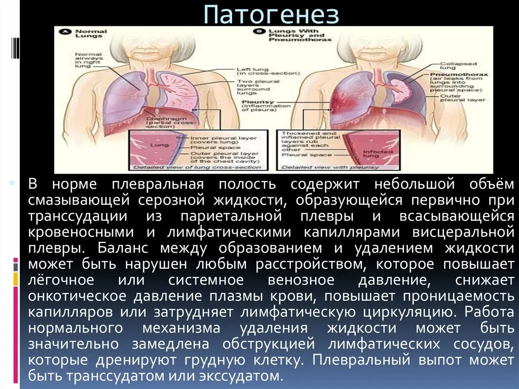 Механизм развития плеврита. Экссудативный плеврит пункция. Экссудативный плеврит этиология. Жидкость а плевральной полости патогенез. Плевральный транссудат