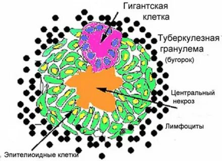 Клетки туберкулезного бугорка