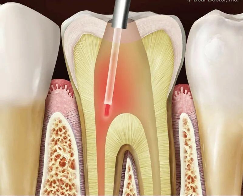 Лазерная терапия пульпита. Препарирование зубов лазером. Эндодонтия в стоматологии.