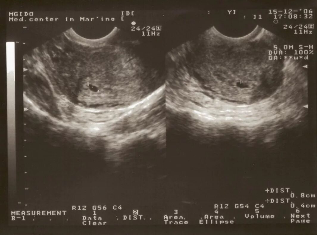 Где то 3 недели. Беременность 3 недели фото эмбриона на УЗИ. Плод в 3 недели беременности на УЗИ. Как выглядит плод в 3 недели на УЗИ. 3 Недели беременности фото плода на УЗИ.