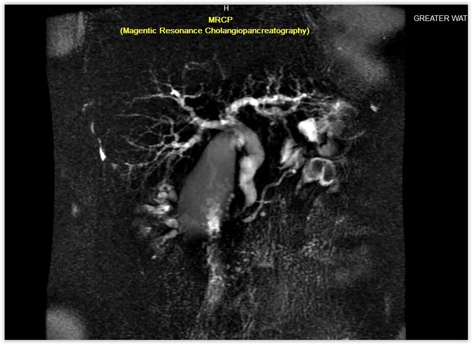 Магнитно-резонансная холангиопанкреатография. Магнитно резонансная холангиопанкреатография МРХПГ. Холангиопанкреатография мрт.