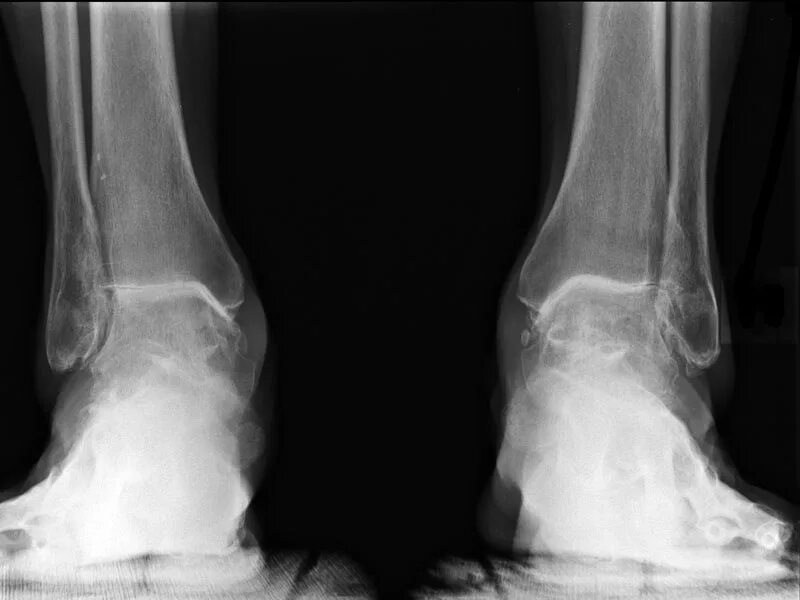 Лигаментоз голеностопного сустава рентген. Артрит голеностопного сустава рентген. Подагра голеностопного сустава рентген. Остеоартрит голеностопного сустава рентген.