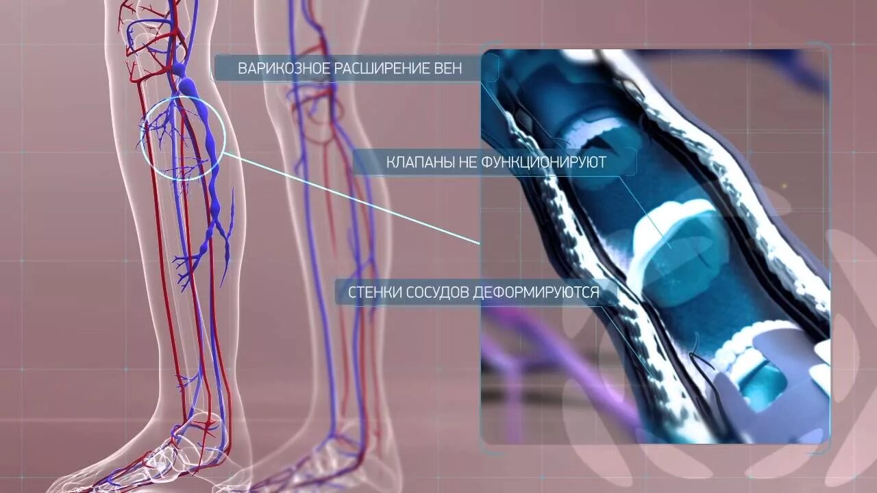 Вены ног клапаны. Варикозное расширение вен нижних. Варикозная болезнь вен клапан. Заболевания вен нижних конечностей. Клапаны вен нижних конечностей.