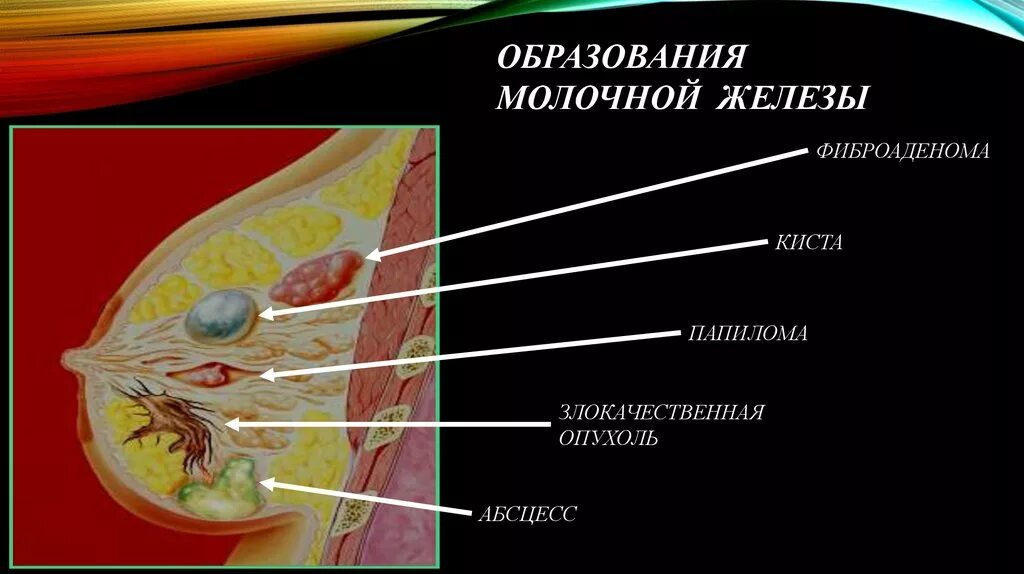 Кистозный солидный образование молочные железа. Образование молочной железы. Фиброаденома молочной железы. Фиброаденома молочной железы симптомы.