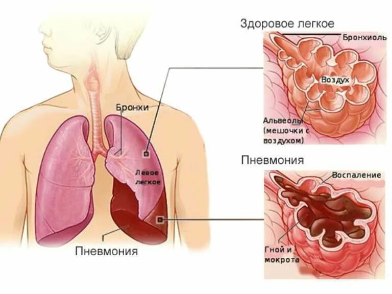 Как проверить есть ли воспаление легких. Как проверить есть ли воспаление легких