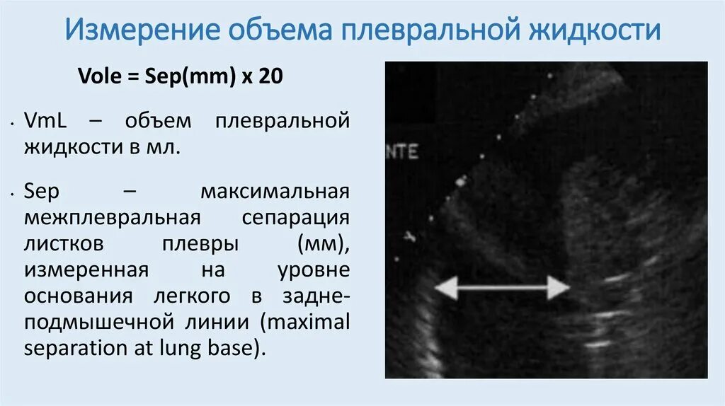 Объем жидкости в плевральной полости. Жидкость в плевральной полости кт. Междолевой плеврит на кт. Жидкость в плевральной полости кт. Экссудативный плеврит кт.