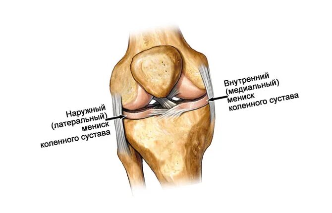 Медиальный мениск коленного сустава. Разрыв мениска коленного сустава. Медиальная менископатия коленного сустава. Разрыв медиального мениска коленного сустава.