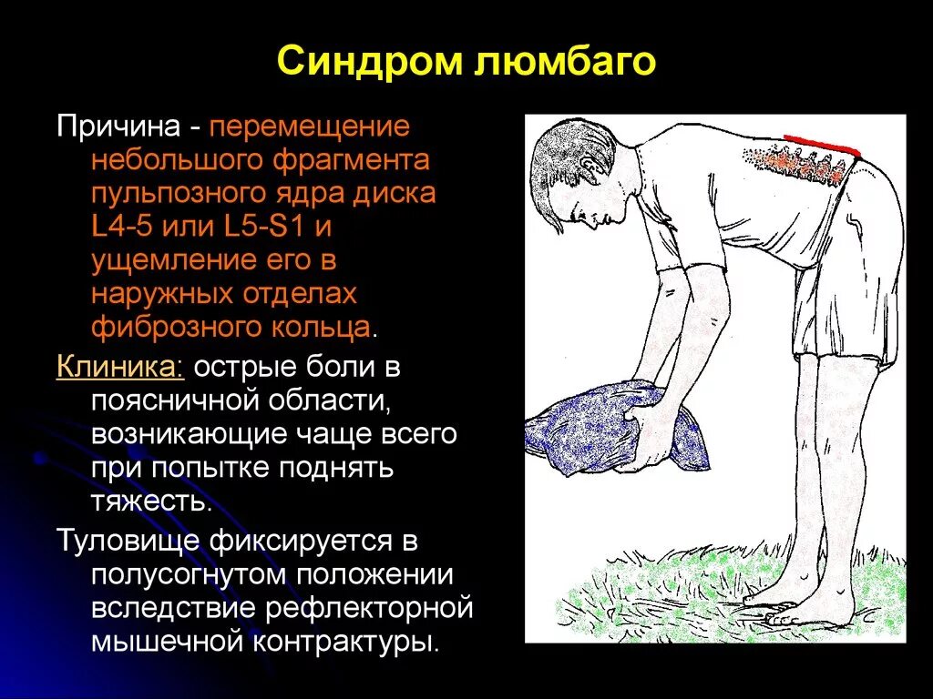 Прострелы в пояснице причины. Люмбаго. Болезнь люмбаго. Люмбаго с ишиасом.