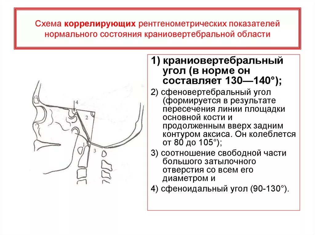 Аномалия перехода. Аномалии краниовертебрального перехода. аномалия краниовертебрального перехода платибазия. рентген краниовертебрального перехода. краниовертебральный угол норма.