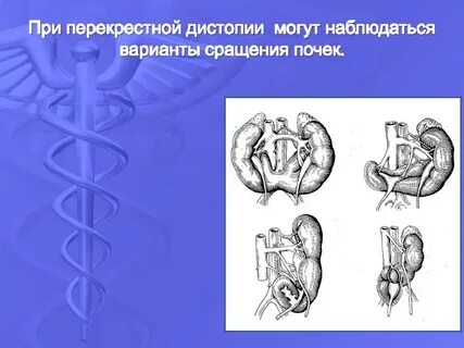 Может ли почка опуститься