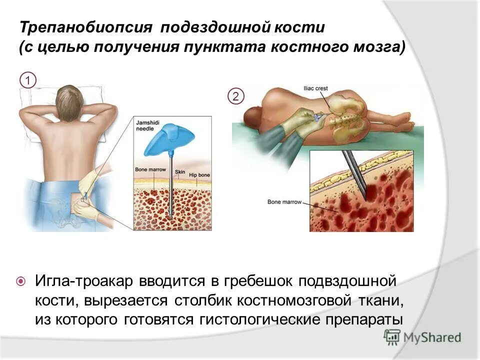 пересадка ко тногомозга. красный костный мозг локализуется. откуда берет костный мозг. косный мост где находится. откуда берет костный мозг.