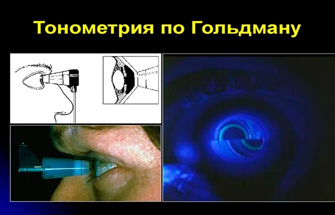 Тонометрия что это. Тонометрия по гольдману. тонометрия по гольдману норма. пальцевая тонометрия глаза.