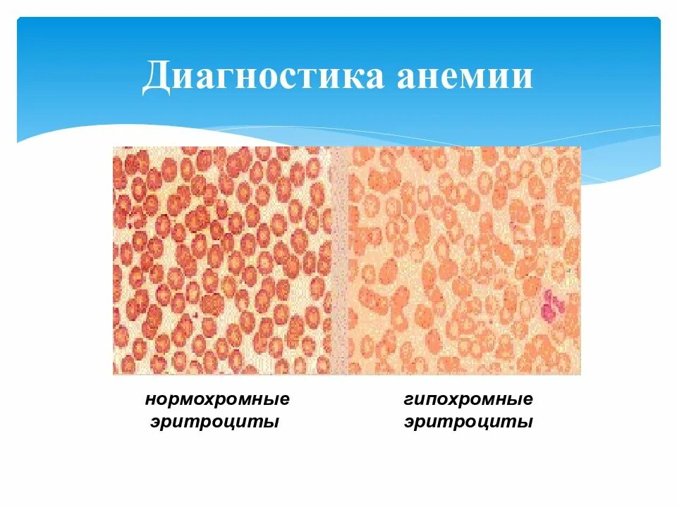 Нормохромная гипохромная анемия. Железодефицитная анемия гипохромная. Гипохромная и гиперхромная анемия. Гипо и гиперхромная анемия. Гипохромная анемия эритроциты.