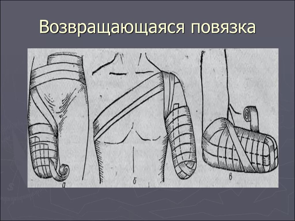 Наложение повязки варежка алгоритм. Возвращающаяся повязка на культю бедра. Возвращающаяся повязка на культю конечности после ампутации. Перевязка возвращающаяся. Возвращающаяся повязка повязка Дезо.