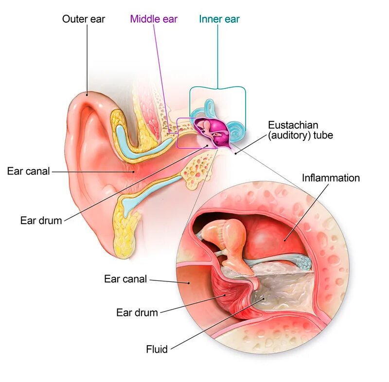 Отит евстахиевой трубы. Евстахиева труба у новорожденного. Воспаление среднего уха. Жидкость в слуховой трубе.