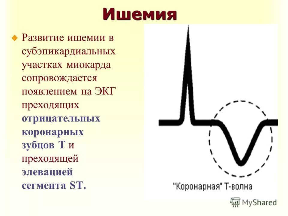 Ишемия т