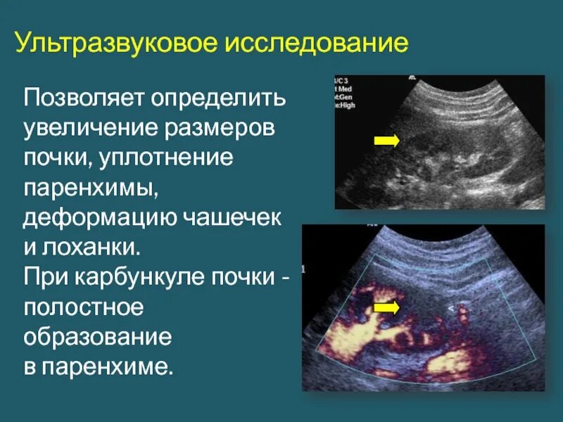 Уплотнение паренхимы почки УЗИ. Гломерулонефрит на УЗИ почек. Паренхима почки на УЗИ. Умеренные диффузные почек