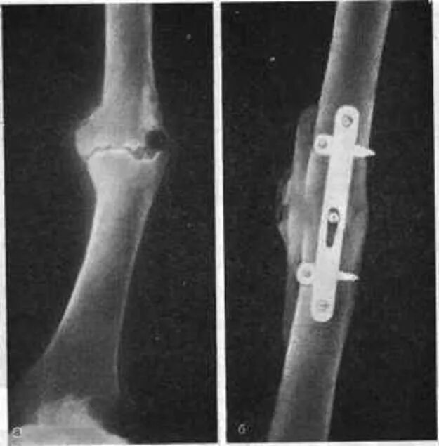 Ложный сустав после перелома бедренной кости. Остеосинтез диафиза лучевой кости. Ложный сустав бедренной кости. Ложный сустав диафиза бедра.