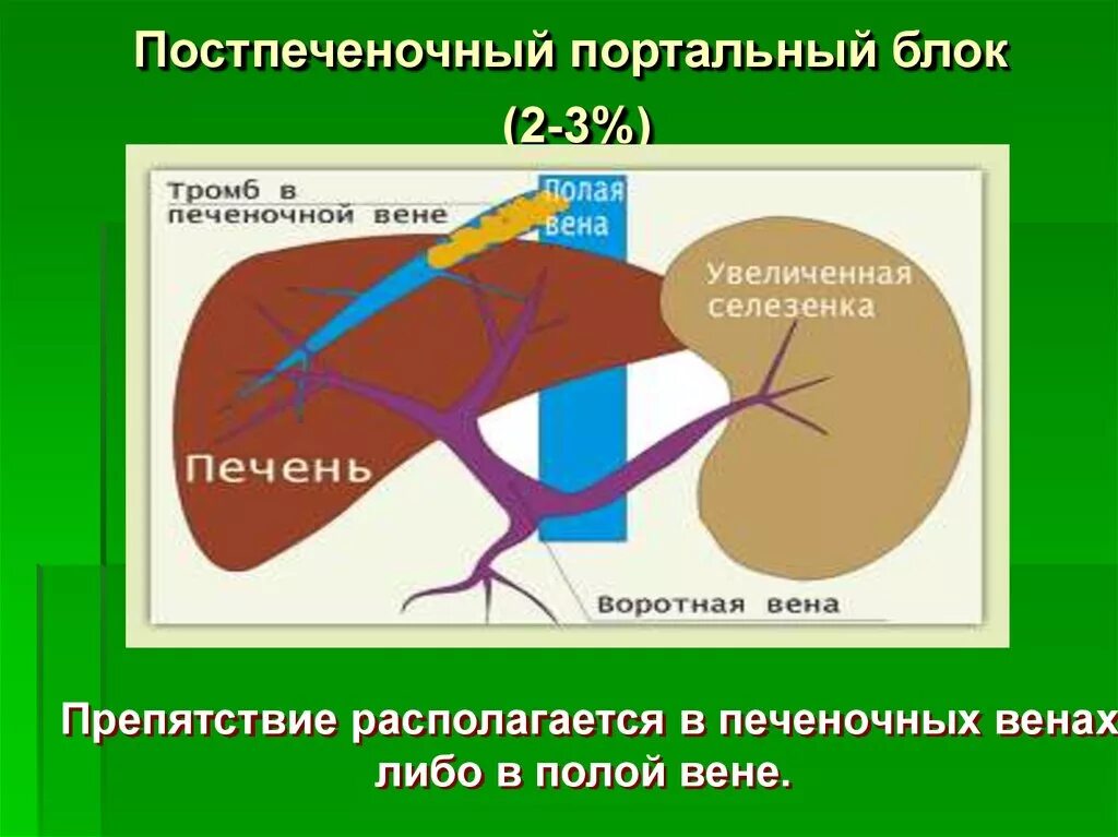 Гипертонии печень. Портальная гипертензия подпеченочный блок. Портальная гипертензия печеночная подпеченочная. Синдром портальной гипертензии внутрипеченочный блок. K76.6 портальная гипертензия.