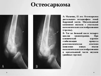 Отек бедренной кости