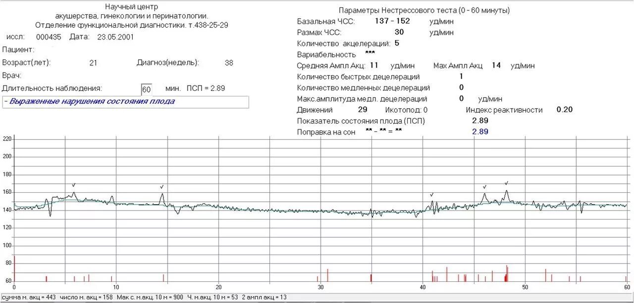 КТГ ПСП 0,14. КТГ беременность расшифровка показателей. Показатели состояния плода КТГ при беременности. ПСП 0 01 КТГ. Нормы ктг 33 недели