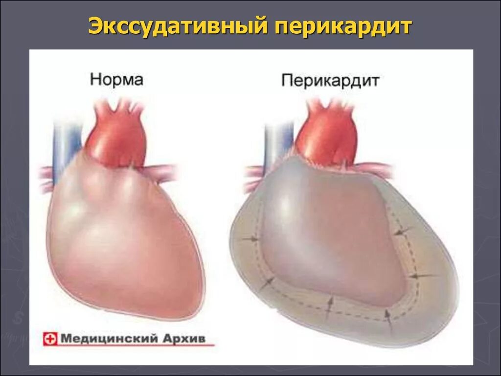 Гидроперикард и экссудативный перикардит. Перикардит гидроперикардит. Экссудативный перикардит границы сердца. Перикард (околосердечная сумка).